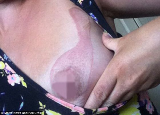iPhone害人不浅！英国女子抱手机入睡 乳房被灼伤