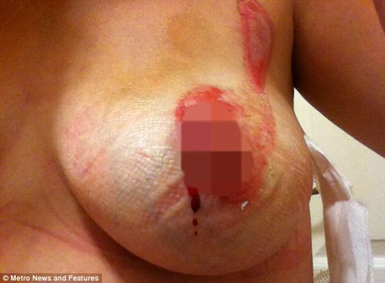 iPhone害人不浅！英国女子抱手机入睡 乳房被灼伤